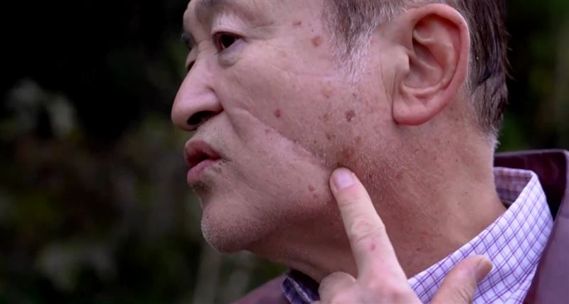 68歲的湊谷圭二（Keiji Minatoya，音譯）臉上有熊攻擊的傷口痕。（圖／翻攝畫面）