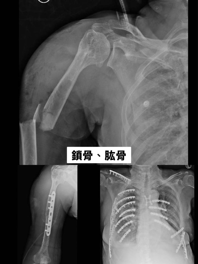 骨科醫師陳柏辰形容，黃婦破碎的骨頭如同散落的拼圖，儘管傷勢嚴重，但她在加護病房仍保持清醒，咬著呼吸管以眼神傳達求生意志，令人動容。（圖／衛福部彰化醫院提供）