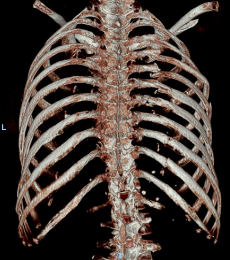 黃婦騎車返家遭小貨車撞，全身多處骨折，光是肋骨就斷了21處，傷勢相當嚴重，緊急送往彰化醫院搶救。（圖／衛福部彰化醫院提供）