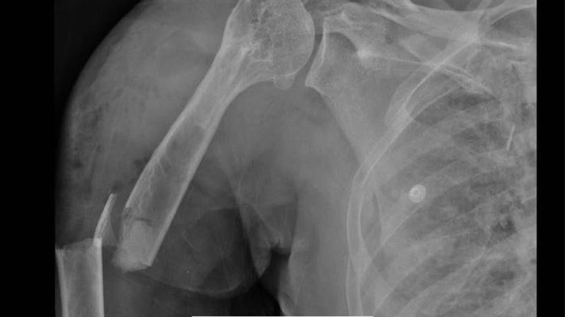 一名70歲黃婦車禍重傷，肋骨斷21處、歷經7次手術，仍堅強求生，「我想活下去」的意志感動醫護，奇蹟重生。（圖／衛福部彰化醫院提供）