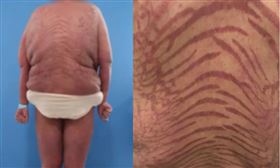 南京一名女病患濫用網上來歷不明的藥膏，導致身上爬滿紫色裂紋，而且身材嚴重發福。（圖／翻攝微博）