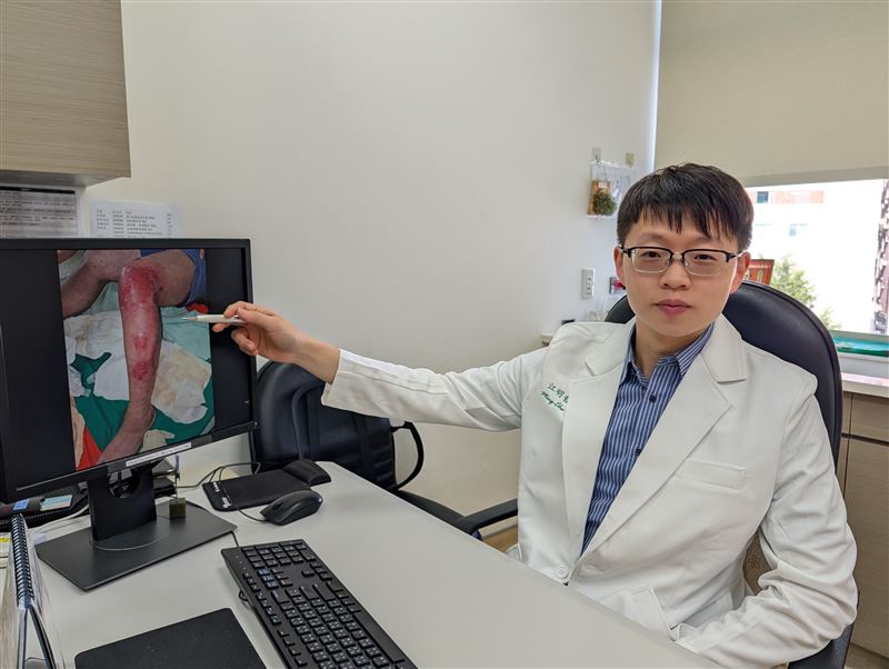 江明哲醫師分享個案,小腿乾癢誤以為只是冬季皮膚乾燥,每天用熱水泡腳並以酒精擦拭止癢,最後出現裂口與紅腫疼痛,就醫後確診為「缺脂性皮膚炎合併蜂窩性組織炎」。(圖/恩主公醫院提供)