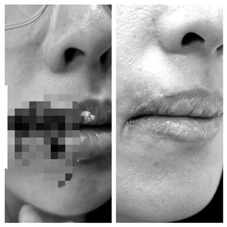 正妹逗狗愛犬突發狂　咬掉她整塊嘴角肉