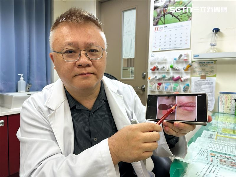 豐原醫院外科醫師陳明澤考量臉部張力與美觀需求，醫療團隊採用美容縫合法重建外觀。（圖／翻攝畫面）