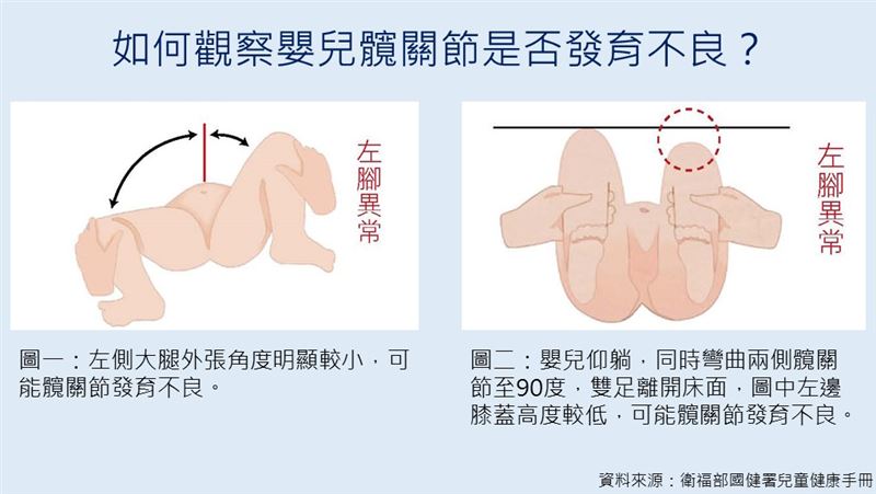 如何觀察嬰兒髖關節是否發育不良。（圖／振興醫院提供）