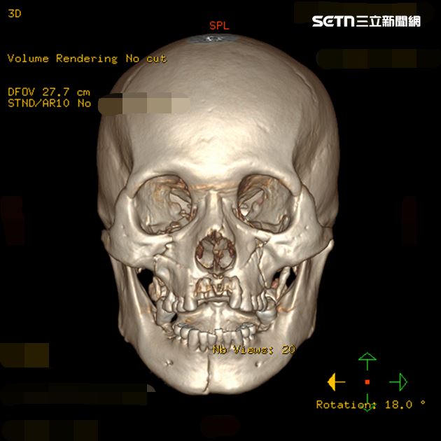 建築工臉部墜地面目全非，當時臉部五官扭曲，顏面嚴重骨折，幾乎全毀。（圖／翻攝畫面）