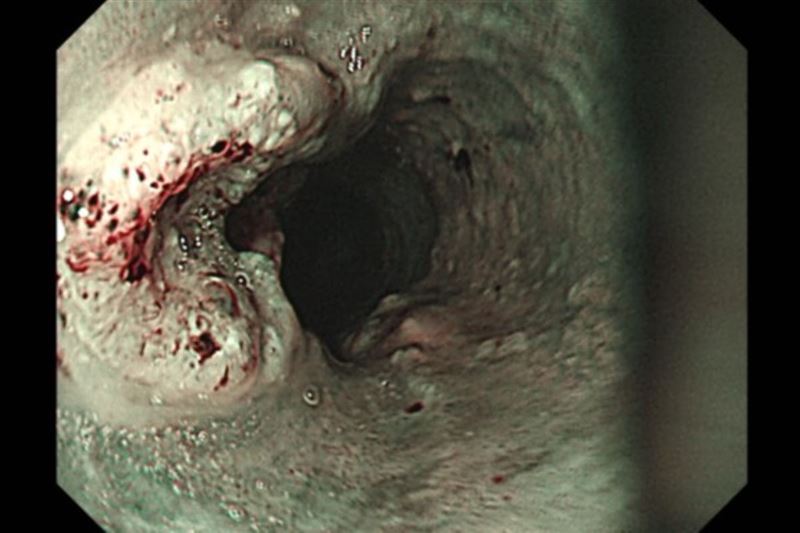 患者胃鏡影像下的食道內側，左側突起處為食道癌病灶。（圖／台北慈濟醫院提供）