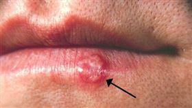 嘴唇長皰疹。(圖/取自維基百科)