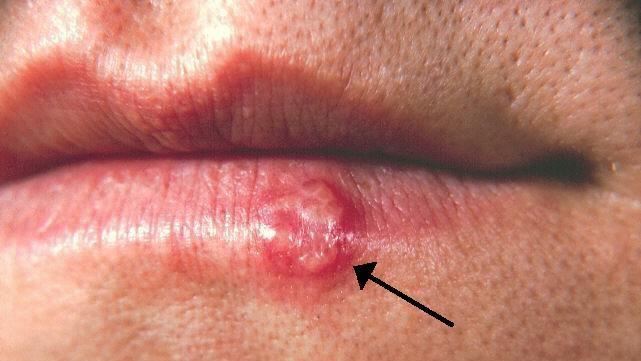 嘴角冒水泡≠火氣大！醫揭「慘烈下場」