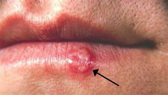 嘴唇長皰疹。(圖/取自維基百科)