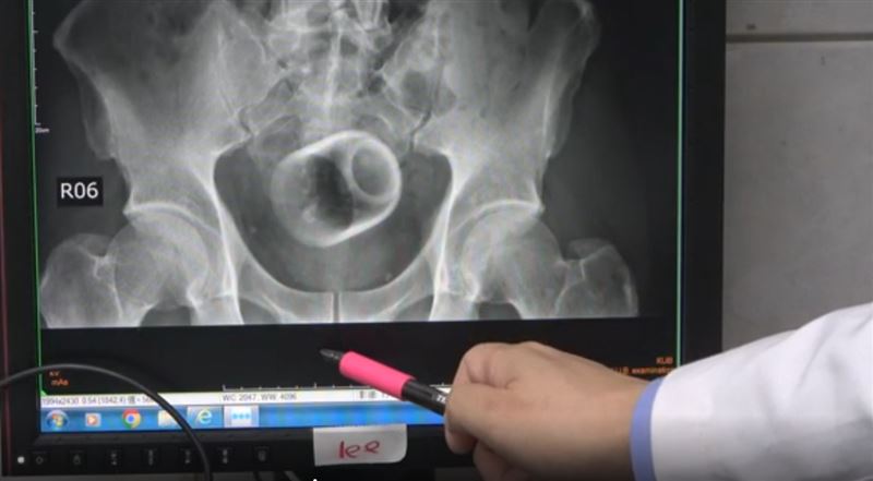 一名中年男子因3天無法解便，腹痛求診，照X光才發現腸子被塞進一個茶杯，緊急開刀取出。(圖／大甲李綜合醫院提供)