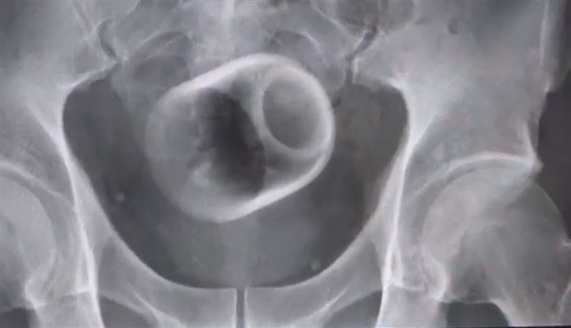 直徑約6公分、高約8公分的陶瓷杯被腸子包住，因杯緣光滑難以夾出，最後只好開刀將杯子順利取出。(圖／大甲李綜合醫院提供)