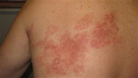 皮膚長痘痘，前胸蔓延到後背，「皮蛇」帶狀疱疹 (示意圖／林新醫院提供)