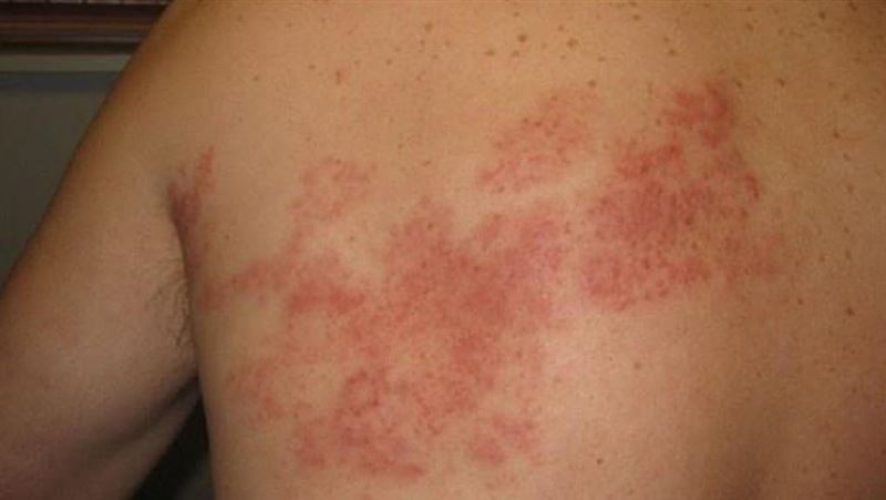 「背後痛得像被火燒！」醫嘆：病毒被喚醒