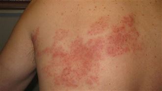 「背後痛得像被火燒！」醫嘆：病毒被喚醒