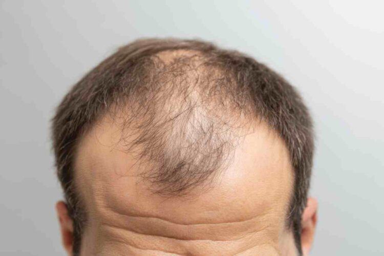 「生髮產品」是智商稅？女性也會雄性禿？ 落髮「都市傳說」醫師一次解析！（圖／醫健新聞網提供）