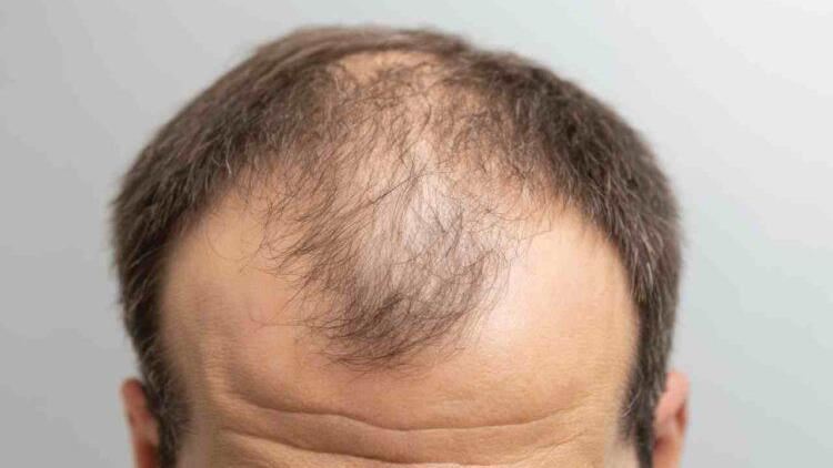 女性也會雄性禿？落髮都市傳說一次解析