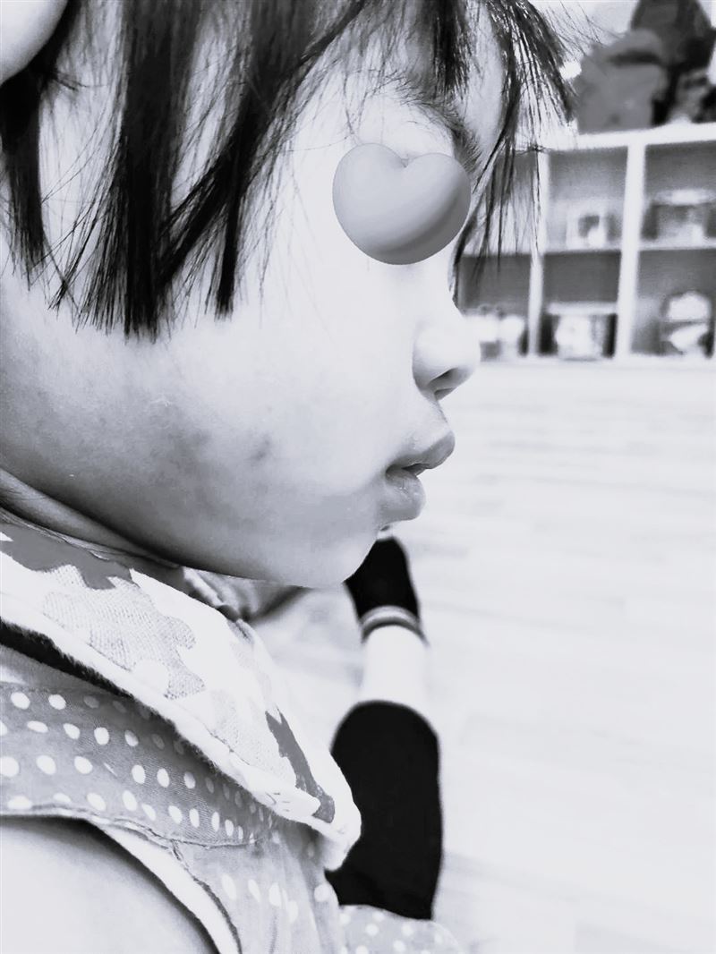 女童受虐後的傷勢。（圖／家長提供）