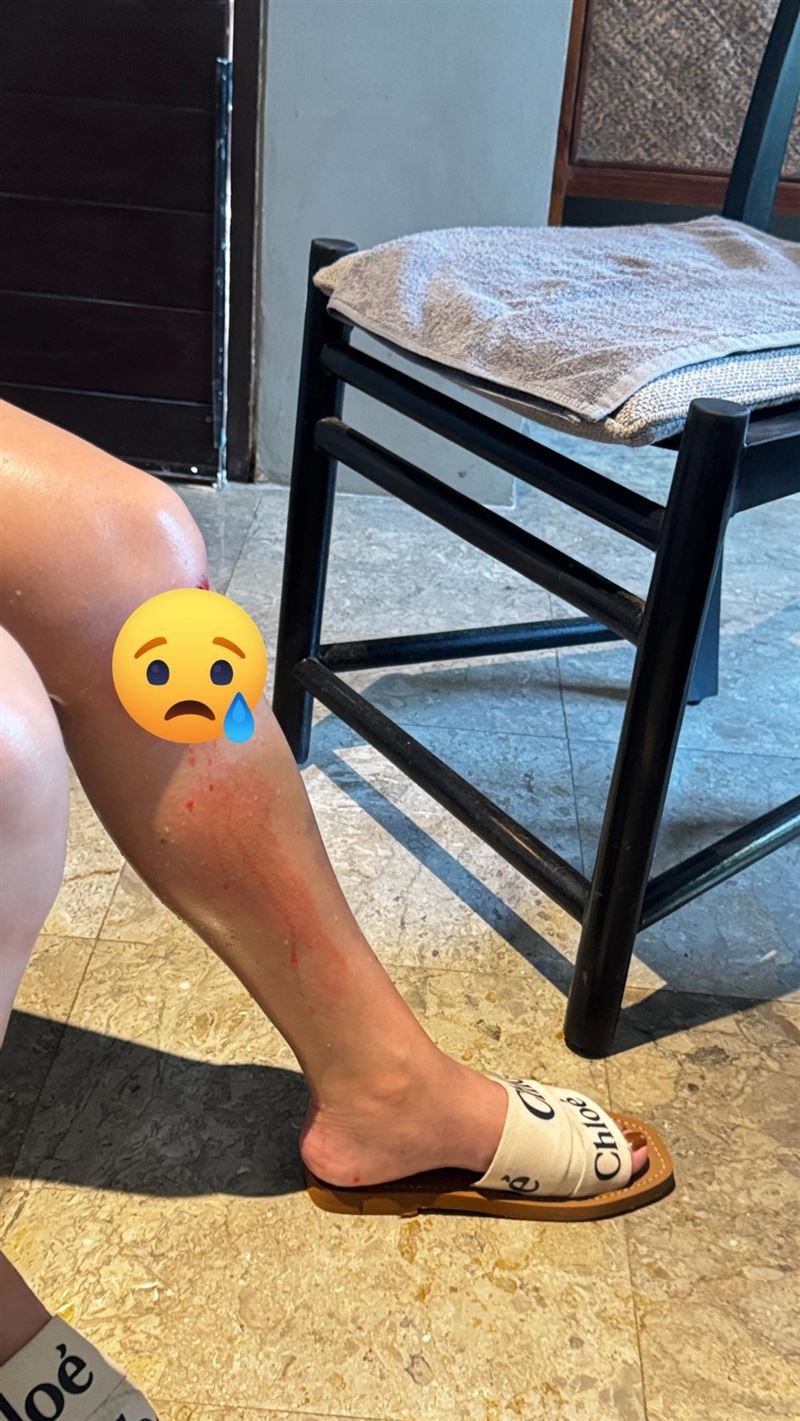 岳啟儒腿部傷勢嚴重。（圖／翻攝自岳啟儒 一人份的勇氣臉書）