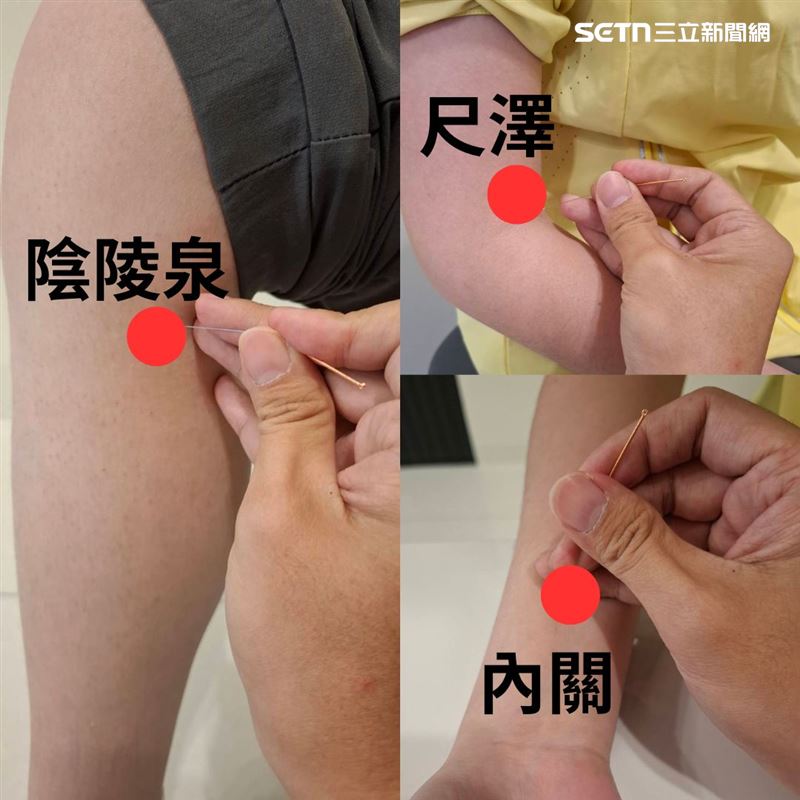 中醫針灸透過刺激如尺澤、內關、陽溪、腕骨等穴位，可有效減輕疼痛並改善手指活動度。（圖／台南市立醫院提供）