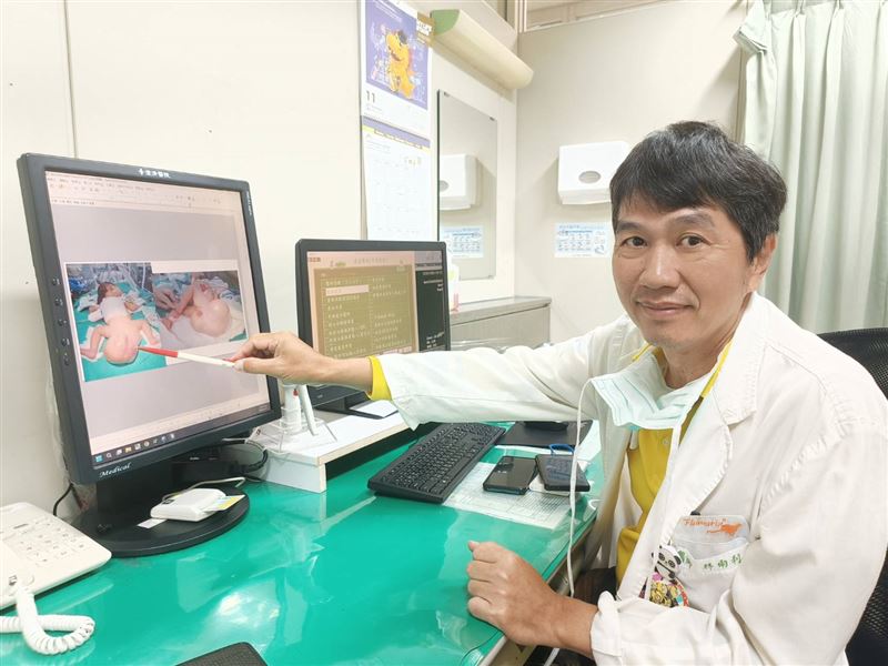 小兒外科主任林雨利診斷，女嬰臀部的大型肉球是先天性尾骶骨畸胎瘤，透過外科手術切除。(圖／澄清醫院中港院區提供)