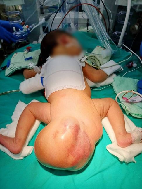 巨大尾骶骨畸胎瘤在10週內竟迅速長大4倍，重達530克。(圖／澄清醫院中港院區提供)