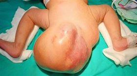 女嬰出生，臀部長16公分，「大球」出生，巨大尾骶骨畸胎瘤，罕見(圖／澄清醫院中港院區提供)