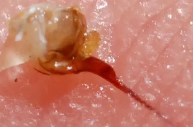 刺入眼瞼的蜂針。（圖／翻攝畫面）