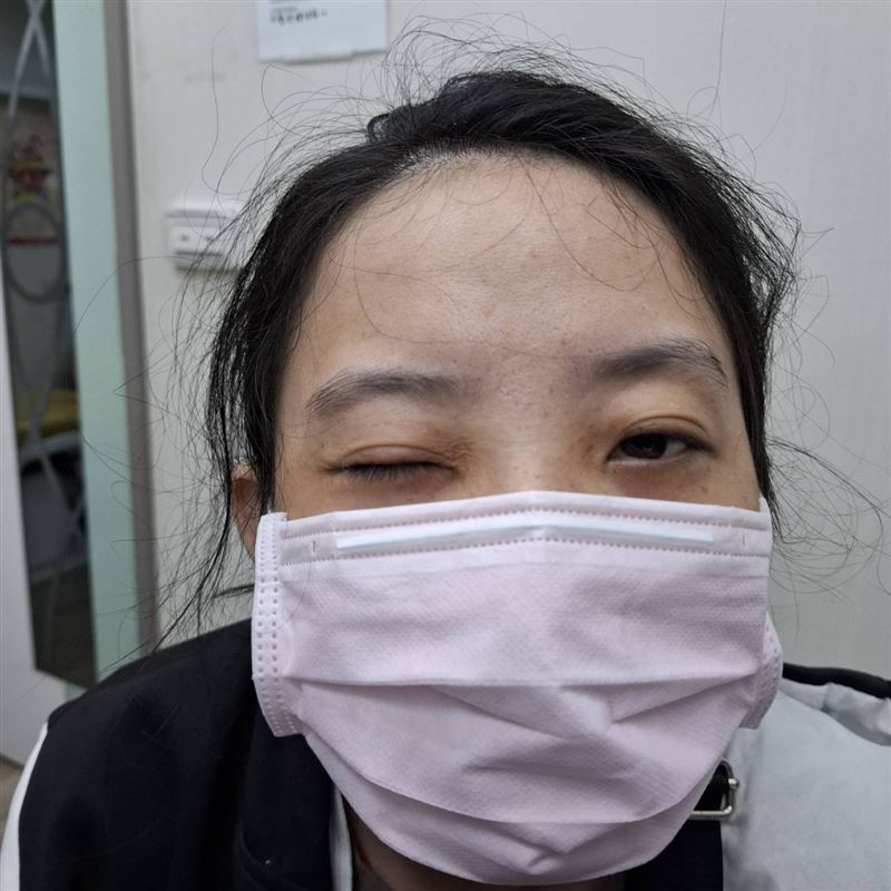 江小姐就醫時，右眼已經完全睜不開。（圖／翻攝畫面）