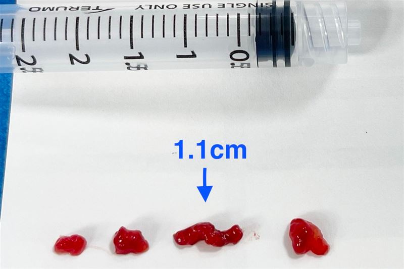 一名14歲學生日前突然倒地,伴隨怪聲、右側肢體癱軟等症狀,檢查確定為左側中大腦動脈栓塞造成缺血性腦中風,左心房還有近7公分的巨大黏液瘤,隨即進行手術取出,4塊血栓中最大達1.1公分。(圖/聯新國際醫院提供)