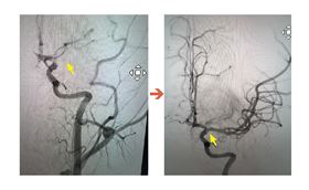 14歲孩子心臟藏7公分「炸彈」 10分鐘緊急完成顱內取栓救回大腦/：ICA血管攝影，圖左箭頭處為血栓阻塞血管。圖右箭頭處為已打通血管。（圖／聯新國際醫院）