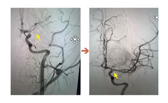 14歲就中風！心臟藏7cm炸彈 醫10分鐘救回