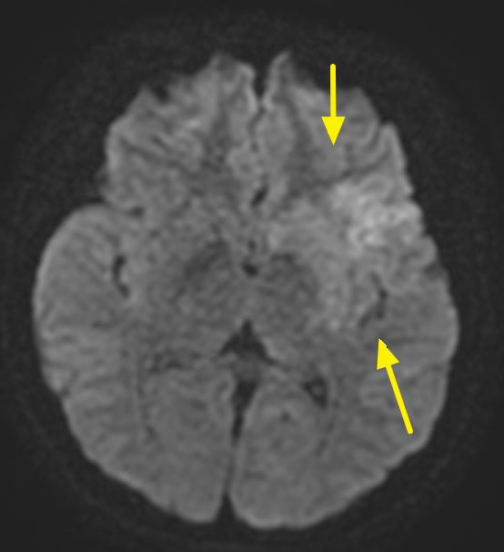 核磁共振影像顯示,箭頭處呈現早期缺血變化。(圖/聯新國際醫院提供)