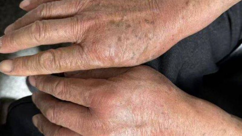 10秒爬滿全身!他被火蟻圍攻險死竟它害的