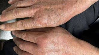 10秒爬滿全身！他被火蟻圍攻險死竟它害的