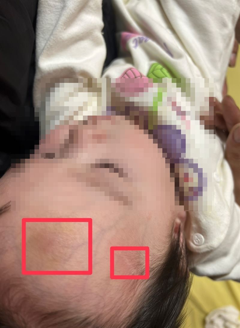男童頭部瘀青傷勢。（圖／投訴人提供）