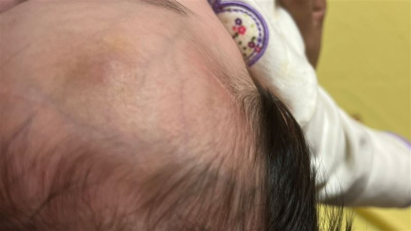 新北遭安置1歲童頭瘀青 社工謊稱蚊子叮