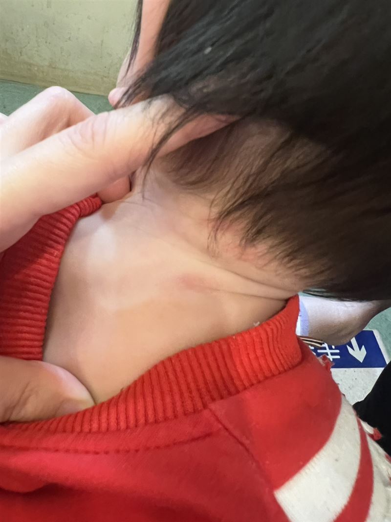 男童身上的濕疹。（圖／投訴人提供）