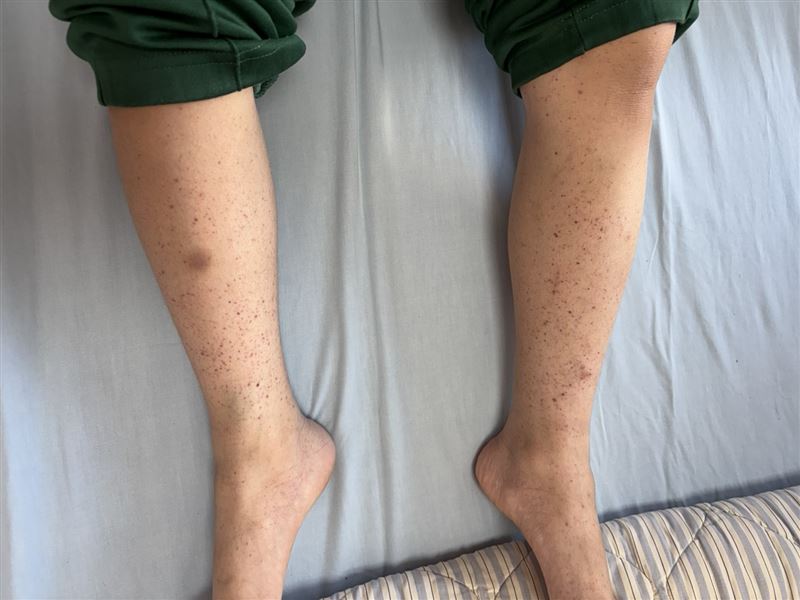 8歲童全身皮膚出現小血斑點，且剔牙弄傷牙齦後血流不止，父母起初擔心罹患血癌，最後確定是「免疫性血小板低下紫斑症」。（圖／衛福部彰化醫院提供）