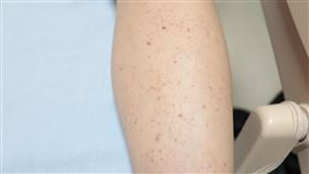 莫名出血點、出血難止，恐是免疫性血小板低下紫斑症。（圖／衛福部彰化醫院提供）