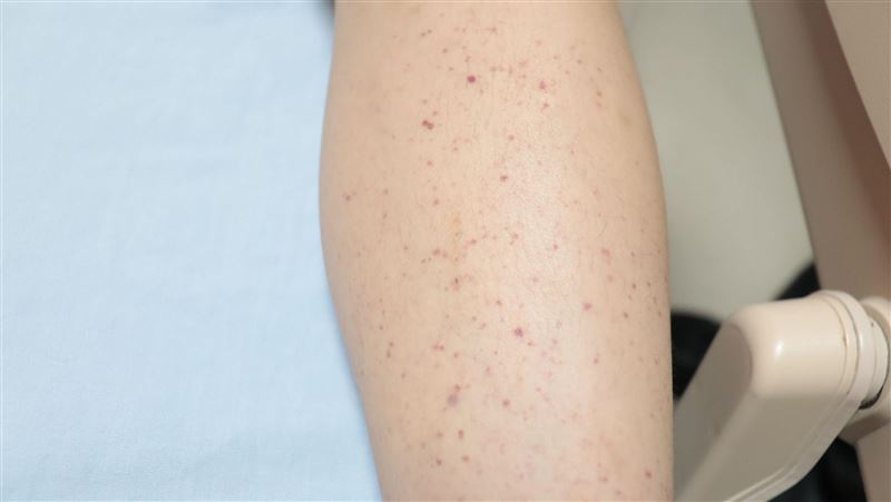 他全身冒血點！剔牙狂流血 醫揭1罕見元凶