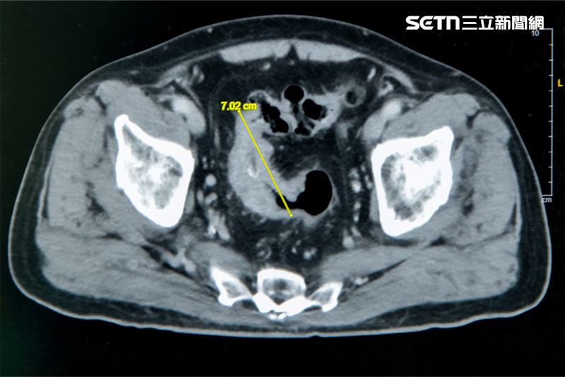 老翁罹患乙狀結腸癌，腫瘤約7公分造成腸子幾乎完全阻塞。（圖／彰基提供）