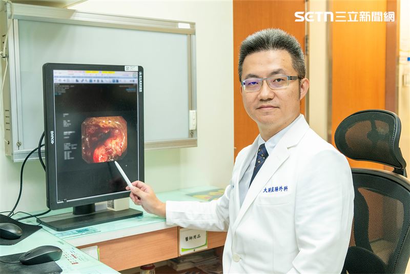 老翁罹患乙狀結腸癌，7公分腫瘤堵住腸道，導致嚴重便秘，1天有12小時待在馬桶上。（圖／彰基提供）