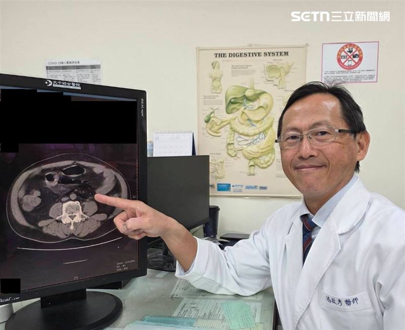 男子因長期便秘，自行拿管子灌腸，不慎捅破直腸引發腹膜炎，差點小命不保。（圖／大千醫院提供）