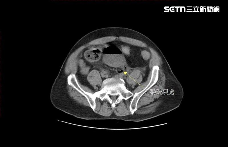 男子因便秘自行灌腸捅破直腸，大量宿便流進腹腔，引發嚴重腹膜炎。（圖／大千醫院提供）
