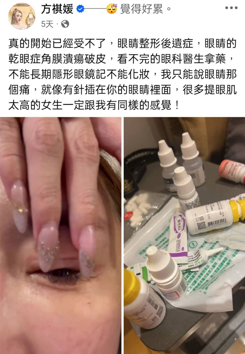 雪碧形容眼睛彷彿有針在插。（圖／翻攝自臉書）