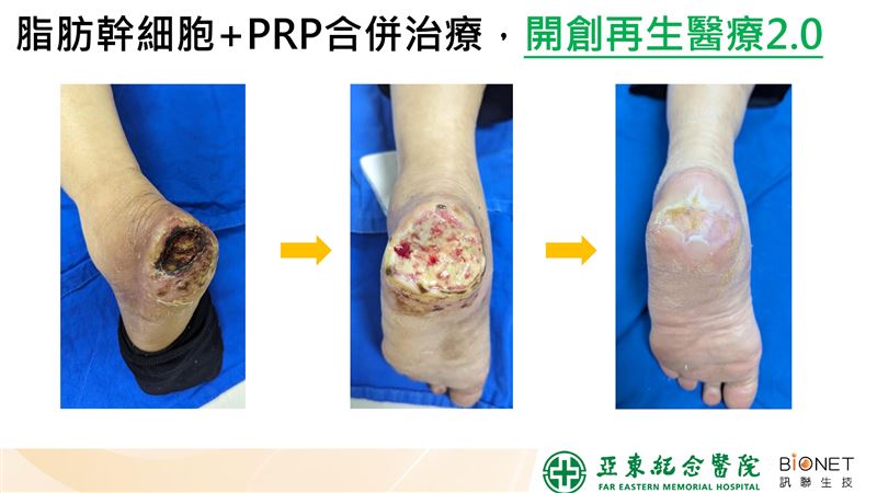 陳女士傷口照。(圖/亞東醫院提供)