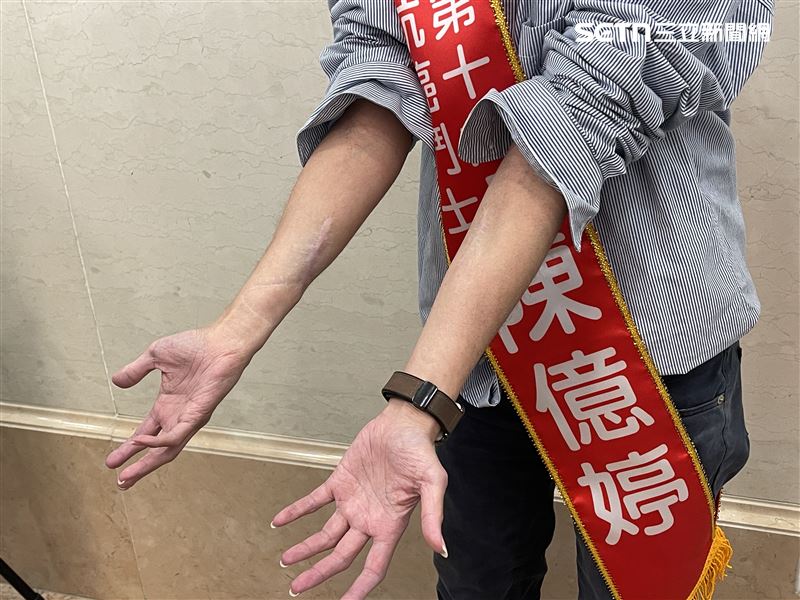 陳億婷雙手長惡性腫瘤，歷經多次手術。（圖／記者蔣季容攝影）