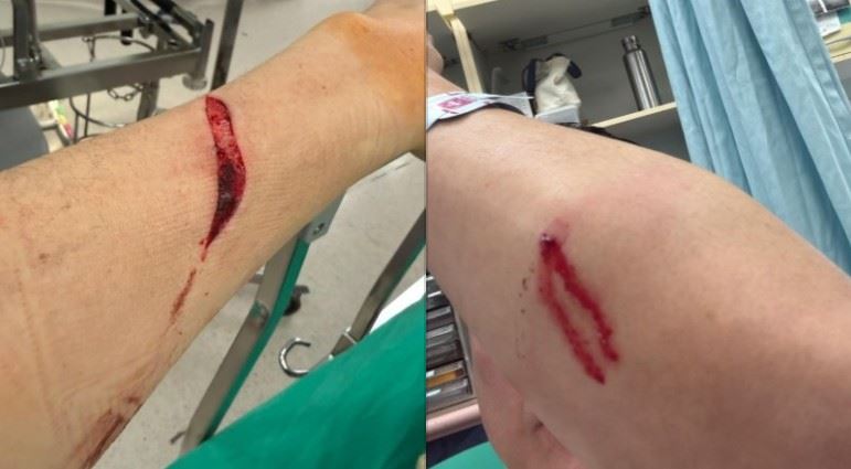 夏天倫遭砍傷。（圖／翻攝自夏天倫Threads）