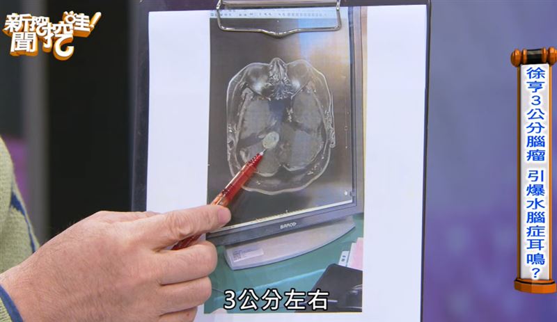 徐亨長腦瘤。（圖／翻攝自新聞挖挖哇YT）